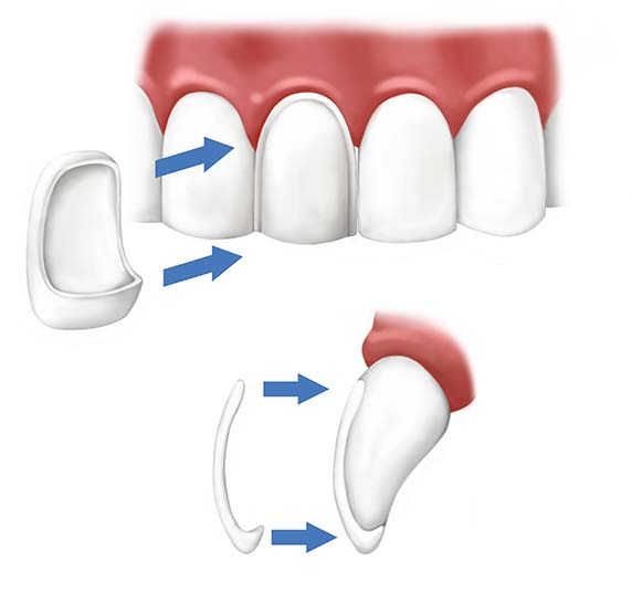 Piani di cura per denti con protesi fisse - Centro Odontoiatrico Atena (BR)